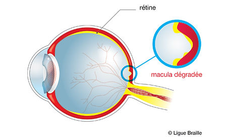 Schéma de la DMLA — Ligue Braille via le site source